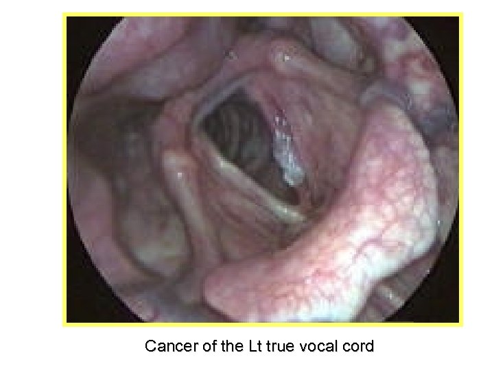 Cancer of the Lt true vocal cord 