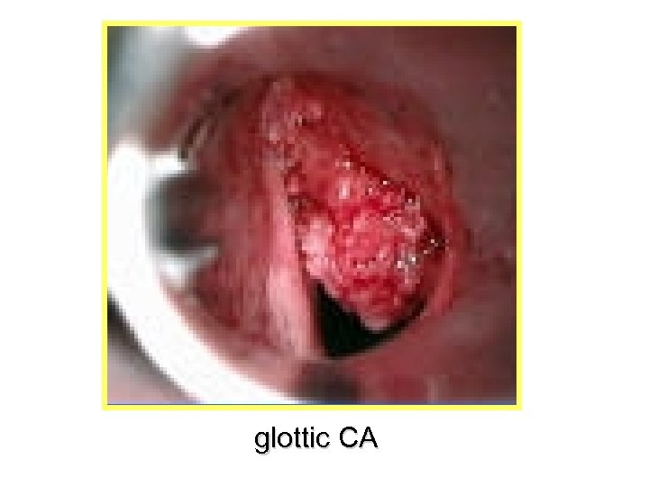 glottic CA 