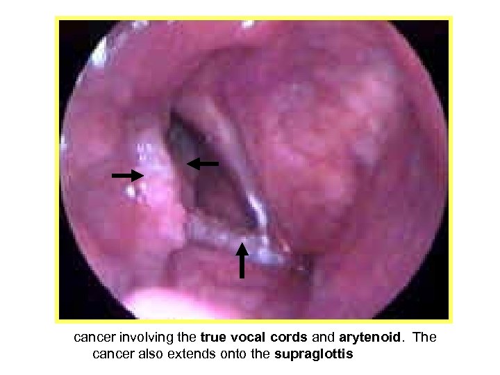 cancer involving the true vocal cords and arytenoid. The cancer also extends onto the