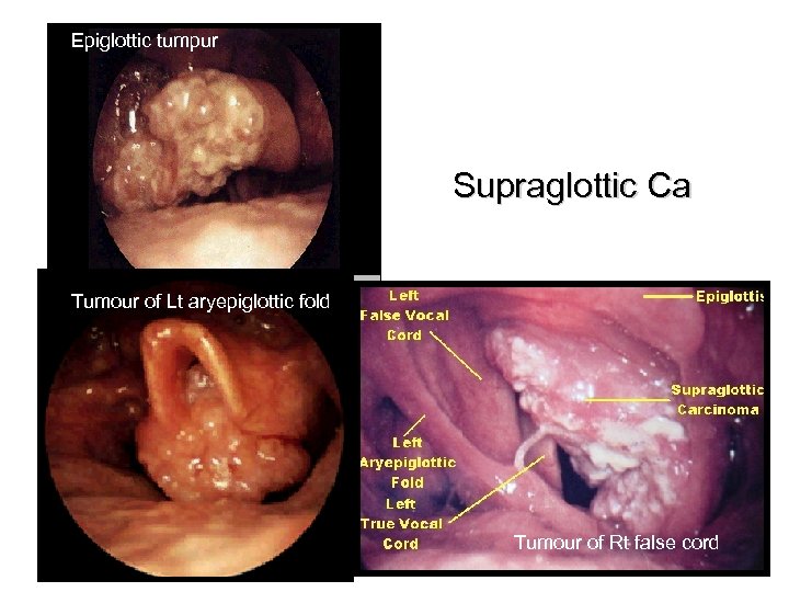 Epiglottic tumpur Supraglottic Ca Tumour of Lt aryepiglottic fold Tumour of Rt false cord