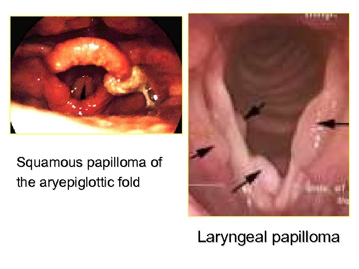 Squamous papilloma of the aryepiglottic fold Laryngeal papilloma 