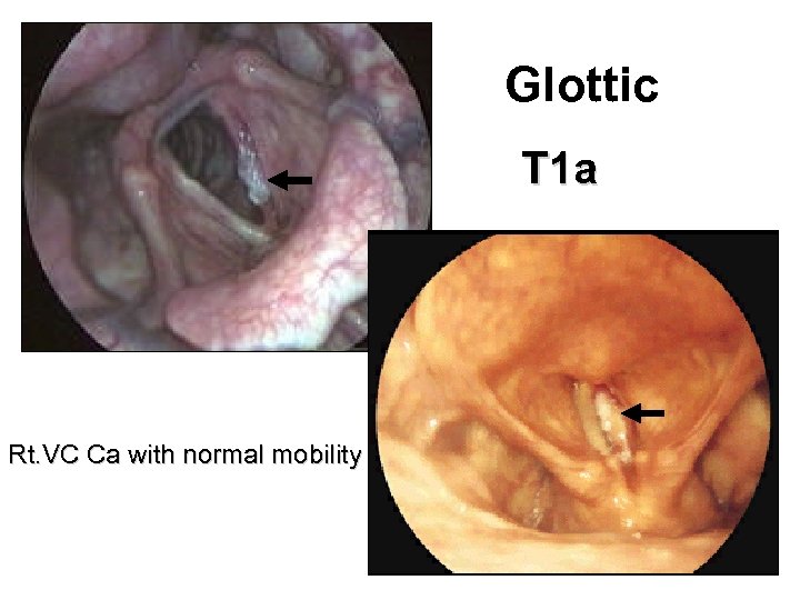 Glottic T 1 a Rt. VC Ca with normal mobility 