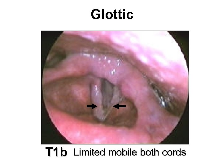 Glottic T 1 b Limited mobile both cords 