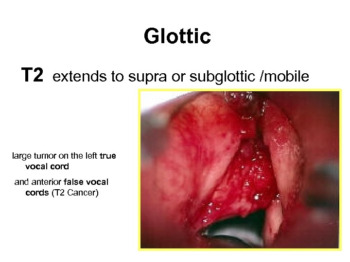 Glottic T 2 extends to supra or subglottic /mobile large tumor on the left