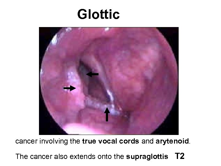 Glottic cancer involving the true vocal cords and arytenoid. The cancer also extends onto