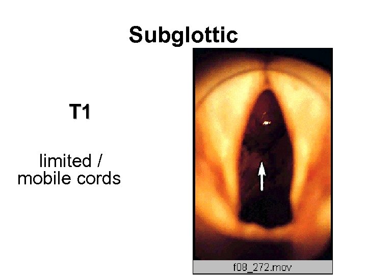 Subglottic T 1 limited / mobile cords 