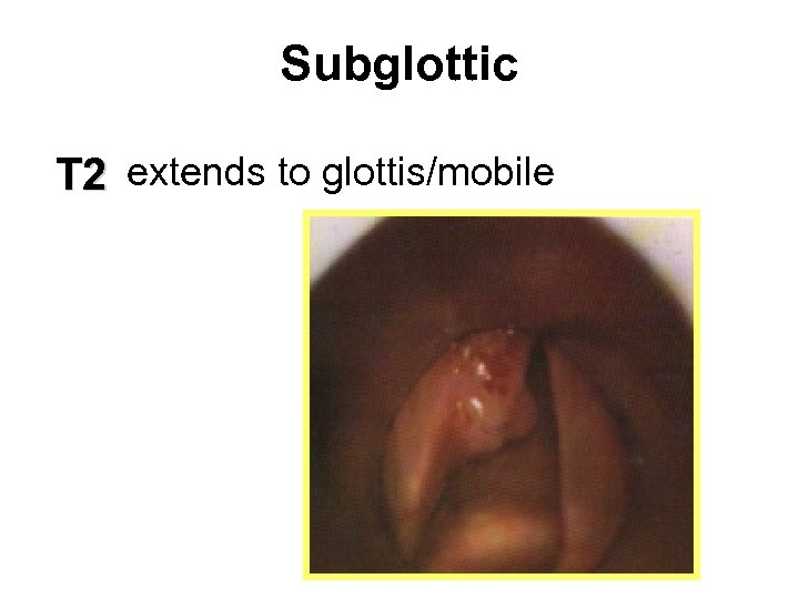 Subglottic extends to glottis/mobile T 2 