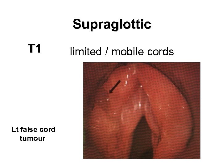 Supraglottic T 1 limited / mobile cords Lt false cord tumour 
