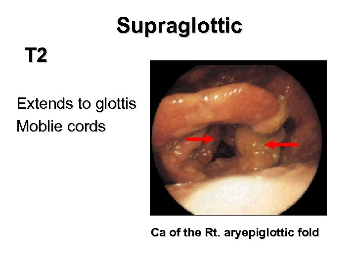Supraglottic T 2 Extends to glottis Moblie cords Ca of the Rt. aryepiglottic fold