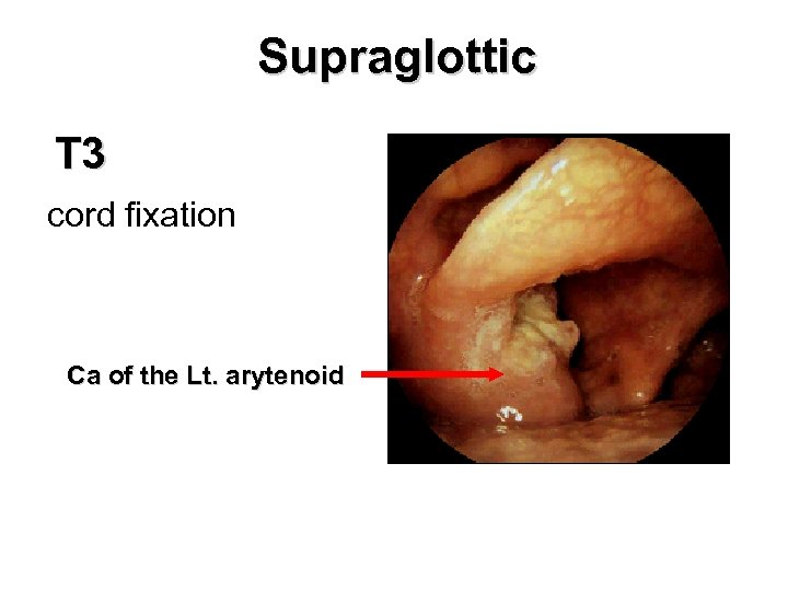 Supraglottic T 3 cord fixation Ca of the Lt. arytenoid 