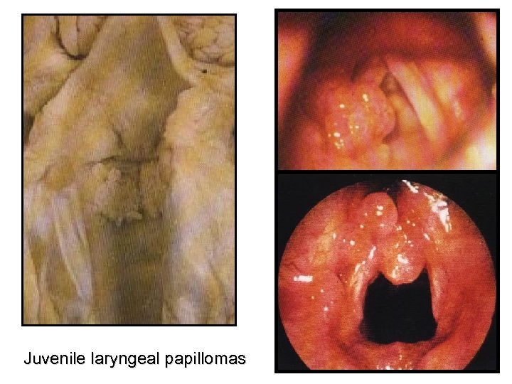 Juvenile laryngeal papillomas 