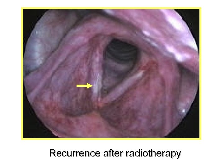 Recurrence after radiotherapy 