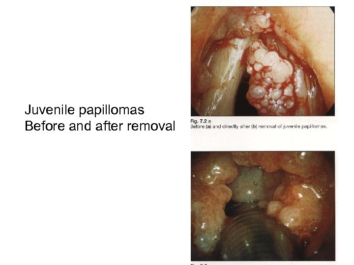 Juvenile papillomas Before and after removal 