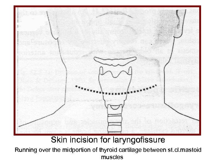 Skin incision for laryngofissure Running over the midportion of thyroid cartilage between st. cl.
