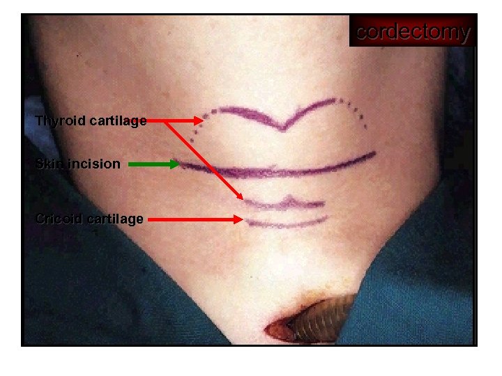 cordectomy Thyroid cartilage Skin incision Cricoid cartilage 