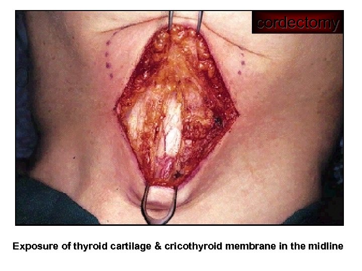 cordectomy Exposure of thyroid cartilage & cricothyroid membrane in the midline 