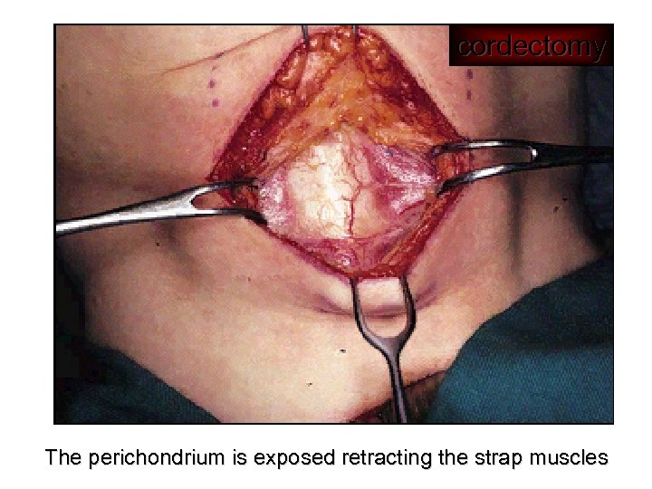 cordectomy The perichondrium is exposed retracting the strap muscles 