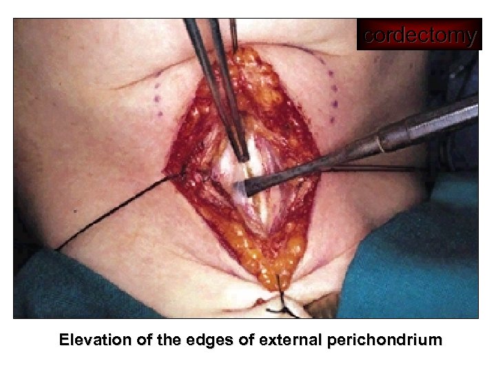 cordectomy Elevation of the edges of external perichondrium 