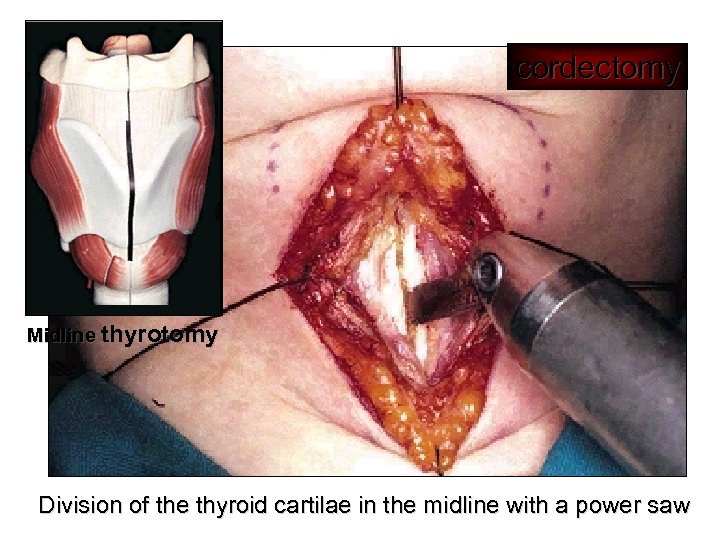 cordectomy Midline thyrotomy Division of the thyroid cartilae in the midline with a power