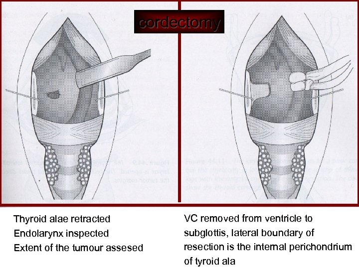 cordectomy Thyroid alae retracted Endolarynx inspected Extent of the tumour assesed VC removed from
