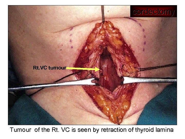 cordectomy Rt. VC tumour Tumour of the Rt. VC is seen by retraction of