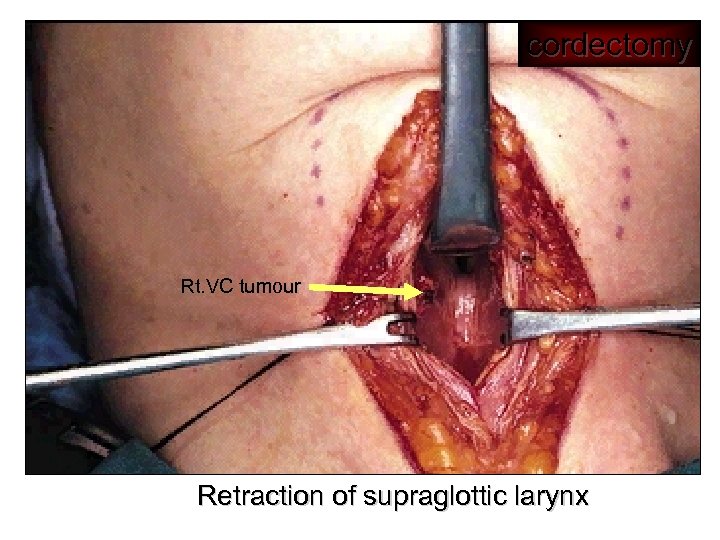 cordectomy Rt. VC tumour Retraction of supraglottic larynx 