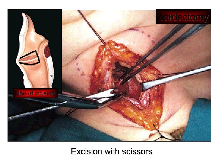 cordectomy Line of incision Excision with scissors 