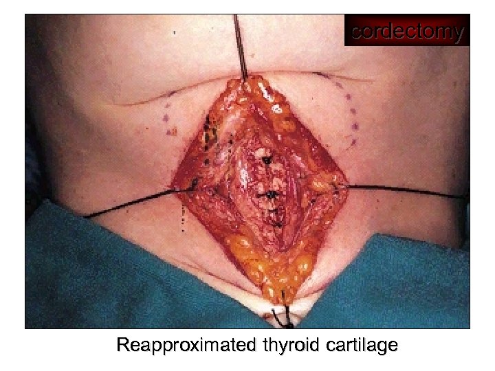 cordectomy Reapproximated thyroid cartilage 