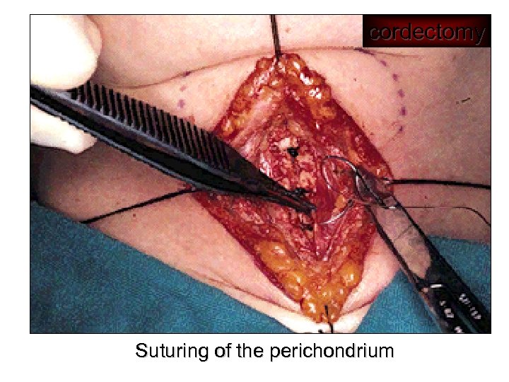 cordectomy Suturing of the perichondrium 