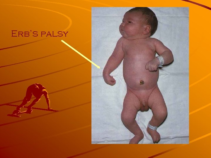 Erb’s palsy 