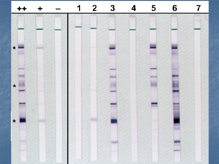 WESTERN BLOT WB NEGATIVO (Ausencia de bandas) INDETERMINADO (cualquier patrón de bandas específicas) POSITIVO