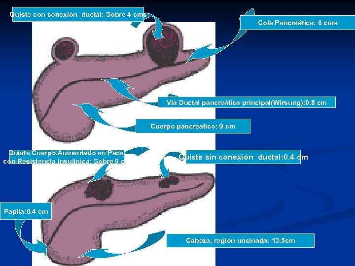 Quiste conexión ductal: Sobre 4 cms Cola Pancreática: 6 cms Via Ductal pancreática principal(Wirsung):