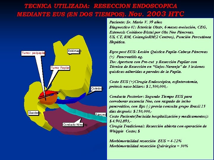 TECNICA UTILIZADA: RESECCION ENDOSCOPICA MEDIANTE EUS (EN DOS TIEMPOS). Nov. 2003 HTC Paciente: Sr.