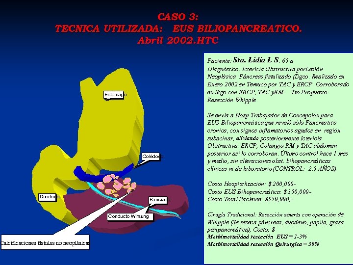 CASO 3: TECNICA UTILIZADA: EUS BILIOPANCREATICO. Abril 2002. HTC Paciente: Sra. Lidia L S.