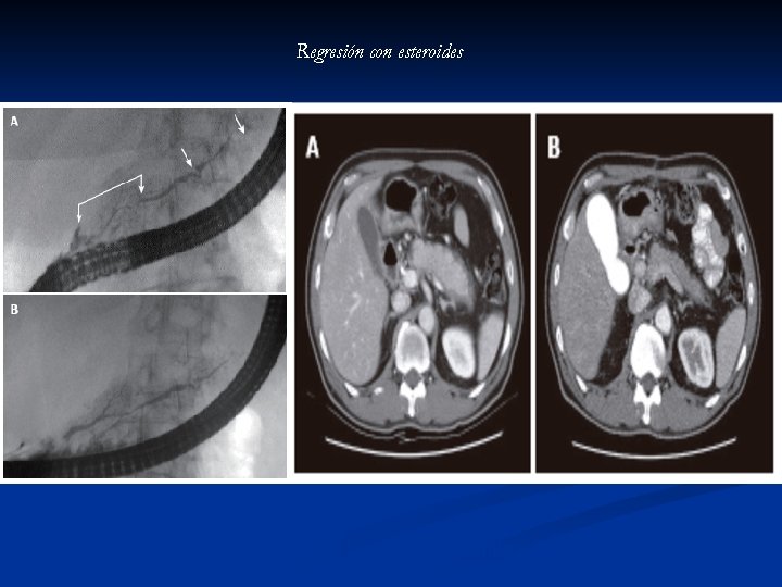 Regresión con esteroides Autoinmmune pancreatitis. Okazaki, Uchida, Matsushita y Takaoka. Internal Medicina, diciembre 2005