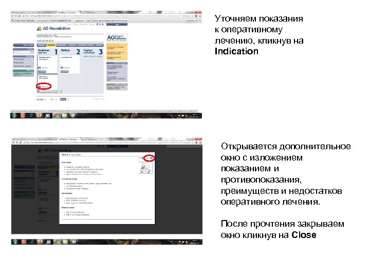 Уточняем показания к оперативному лечению, кликнув на Indication Открывается дополнительное окно с изложением показанием