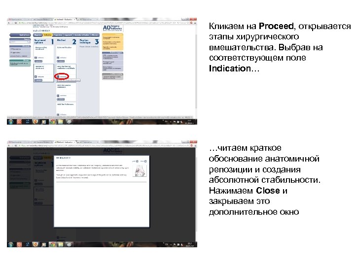 Кликаем на Proceed, открывается этапы хирургического вмешательства. Выбрав на соответствующем поле Indication… …читаем краткое