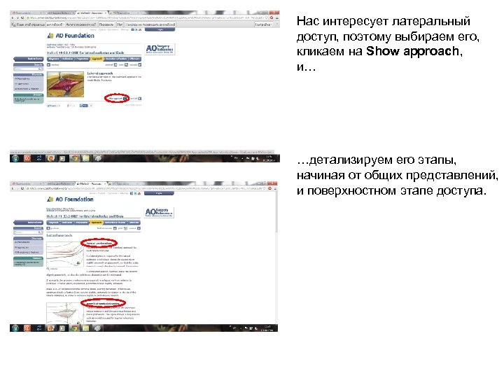 Нас интересует латеральный доступ, поэтому выбираем его, кликаем на Show approach, и… …детализируем его