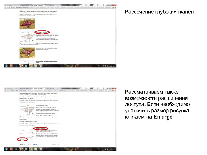 Рассечение глубоких тканей Рассматриваем также возможности расширения доступа. Если необходимо увеличить размер рисунка –
