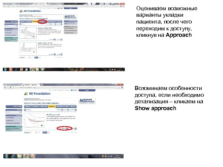 Оцениваем возможные варианты укладки пациента, после чего переходим к доступу, кликнув на Approach Вспоминаем