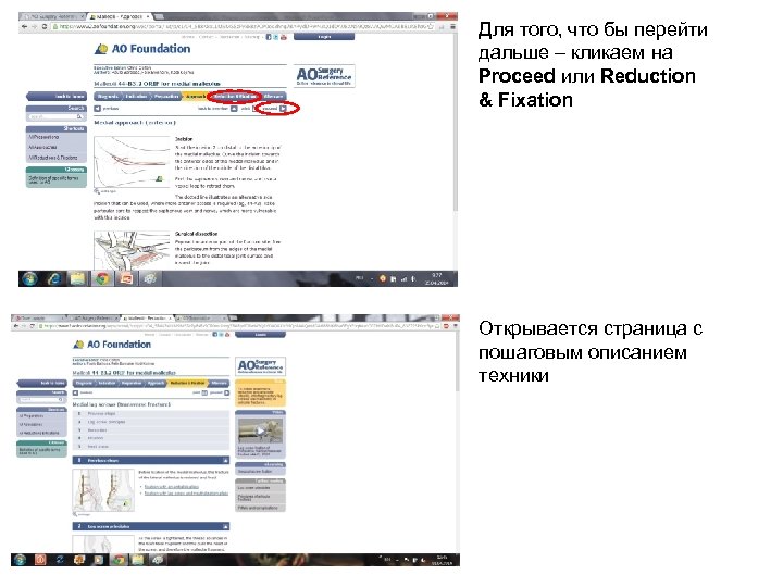 Для того, что бы перейти дальше – кликаем на Proceed или Reduction & Fixation