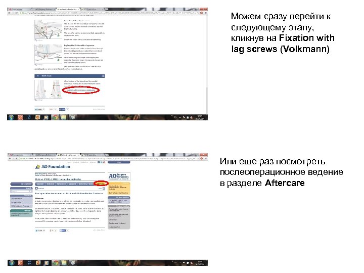 Можем сразу перейти к следующему этапу, кликнув на Fixation with lag screws (Volkmann) Или