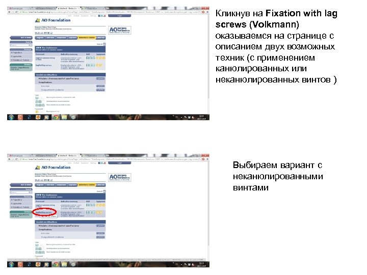 Кликнув на Fixation with lag screws (Volkmann) оказываемся на странице с описанием двух возможных
