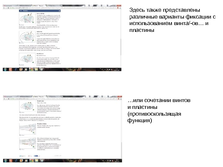Здесь также представлены различные варианты фиксации с использованием винта/-ов… и пластины …или сочетании винтов