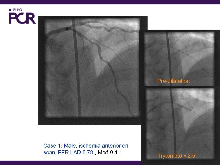 Pre-dilatation Case 1: Male, ischemia anterior on scan, FFR LAD 0. 79 , Med