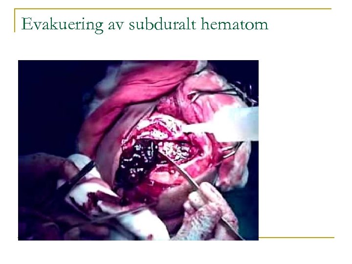 Evakuering av subduralt hematom 