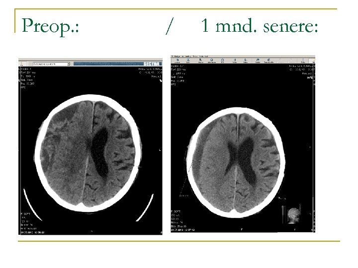 Preop. : / 1 mnd. senere: 