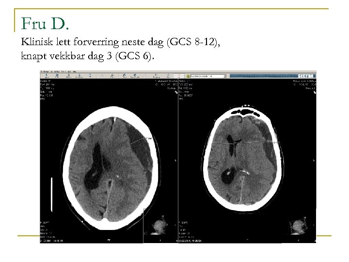 Fru D. Klinisk lett forverring neste dag (GCS 8 -12), knapt vekkbar dag 3