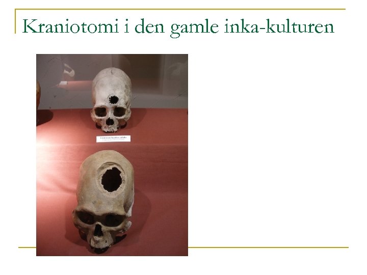 Kraniotomi i den gamle inka-kulturen 