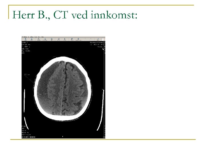 Herr B. , CT ved innkomst: 